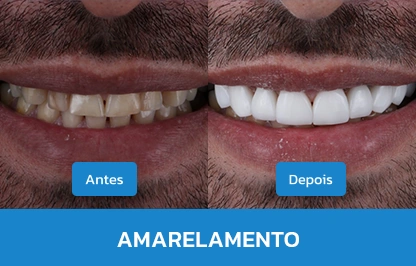 AMARELAMENTO 1