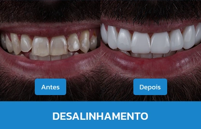 DESALINHAMENTO 1