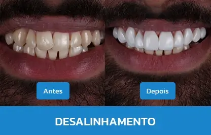 DESALINHAMENTO-1