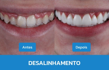 DESALINHAMENTO 2