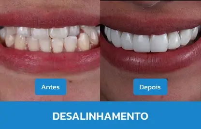 DESALINHAMENTO