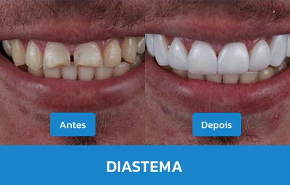 DIASTEMA 1