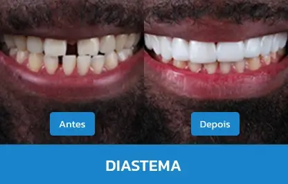DIASTEMA-1