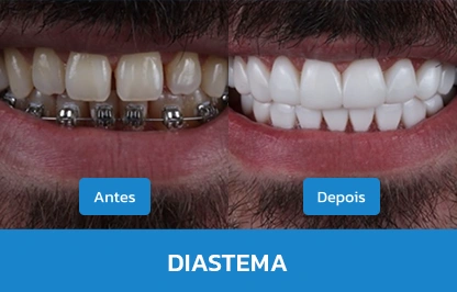 DIASTEMA 2
