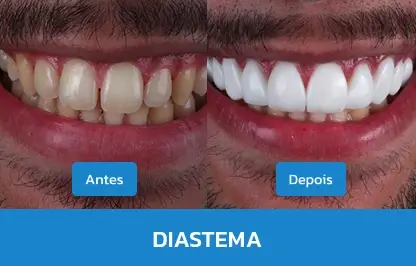 DIASTEMA